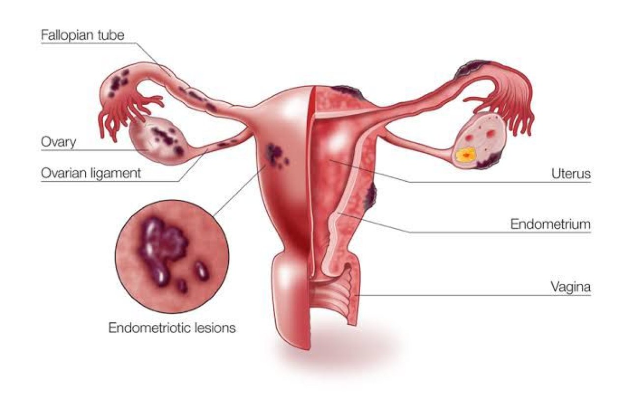 Endometriozis (Çikolata kisti Hastalığı ) neden önemli ?
